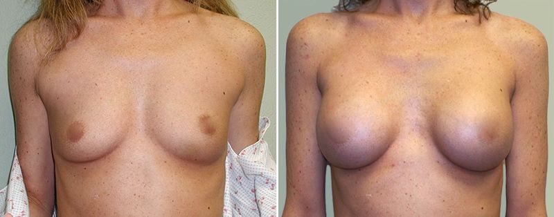 breast-implants-oklahoma-city